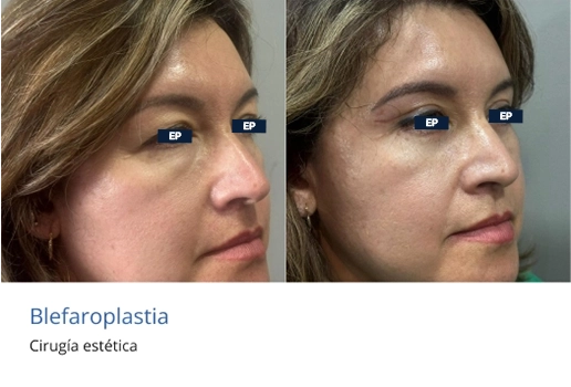 blefaroplastia en morelia cirugia de parpados 1