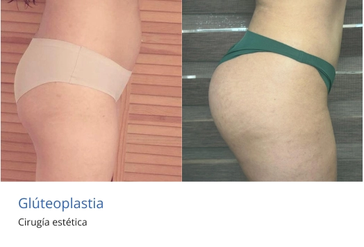 gluteoplastia en morelia