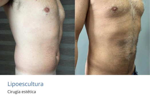 lipoescultura masculina en morelia