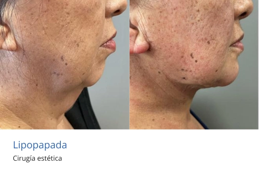 lipopapada en morelia