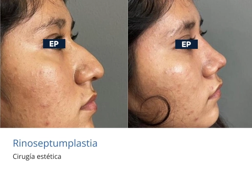 rinoplastia en morelia 1