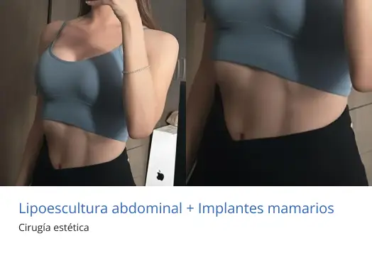 abdominoplastia e implantes mamarios en morelia