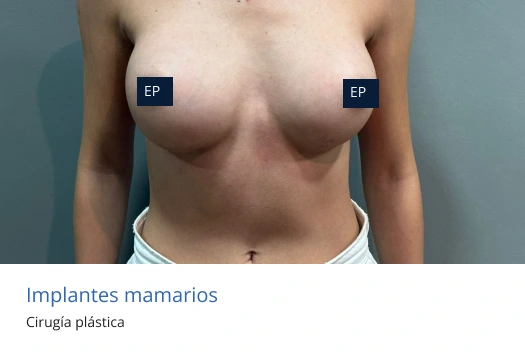 aumento mamario en morelia