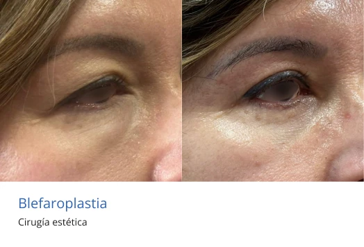 blefaroplastia
