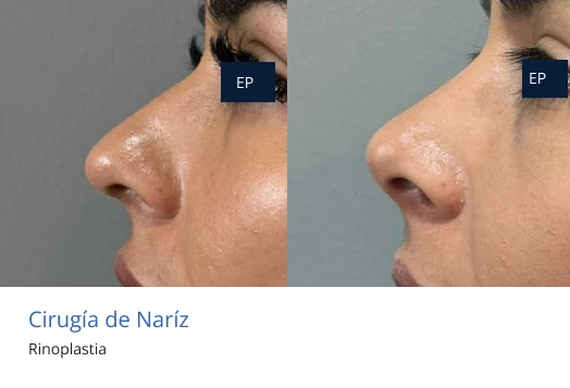 cirugía de nariz