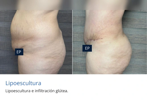 lipoescultura en morelia