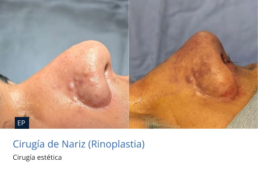 rinoplastia masculina en morelia