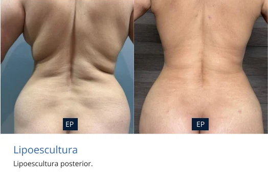 lipoescultura en Morelia Michoacan