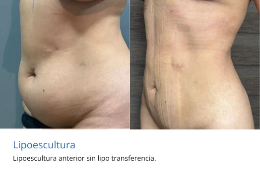 lipoescultura en Morelia