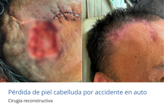 cirugia reconstructiva en cabeza